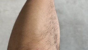 骑车摔伤了 骑车摔伤了